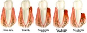 Evolución de periodontitis