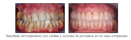 👉COMO se ponen las 𝘾𝘼𝙍𝙄𝙇𝙇𝘼𝙎 𝙙𝙚 𝙋𝙊𝙍𝘾𝙀𝙇𝘼𝙉𝘼 en los dientes  [Te lo explico FÁCIL , COMPRUEBALO✓] 