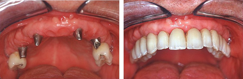 Implantes dentales en pérdida de varios dientes