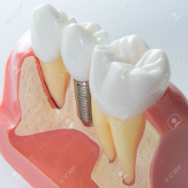 Servicio implante dental